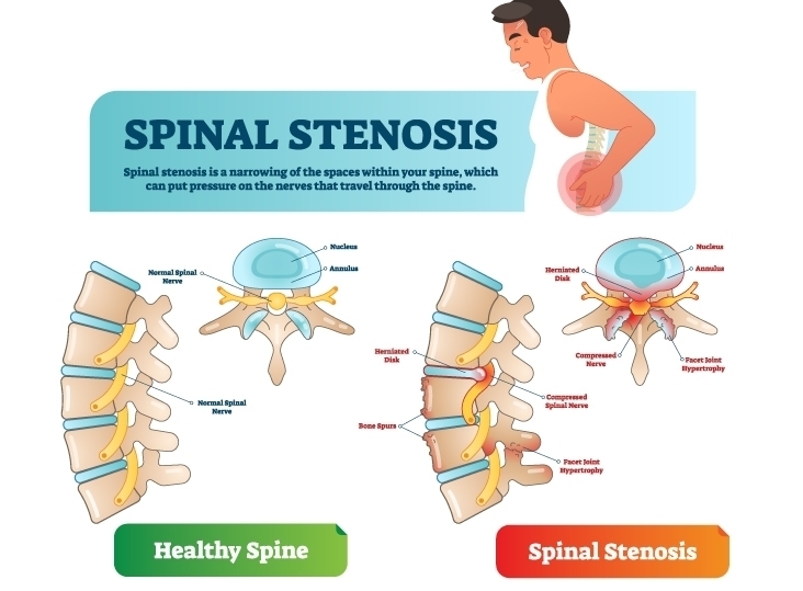 ปวดหลัง จากโพรงกระดูกสันหลังตีบแคบ Spinal stenosis