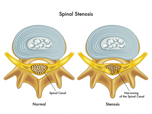 ปวดหลัง จากโพรงกระดูกสันหลังตีบแคบ Spinal stenosis